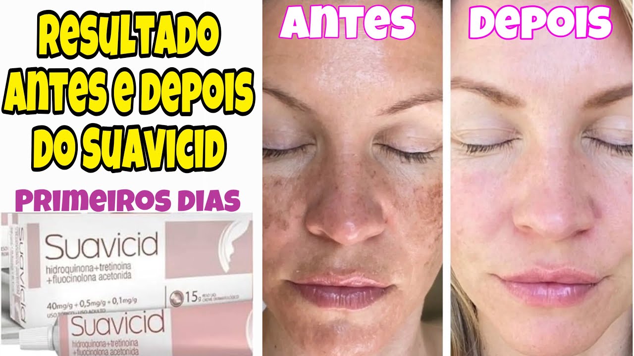MELASMA: RESULTADOS NA PRIMEIRA SEMANA 😱COMECEI a usar SUAVICID! - YouTube