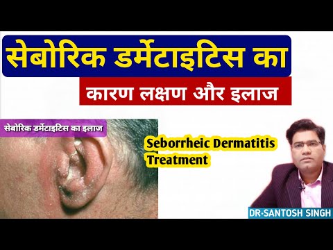 What Are Seborrheic Dermatitis [ Dandruff ] Cause Symptoms and Treatment