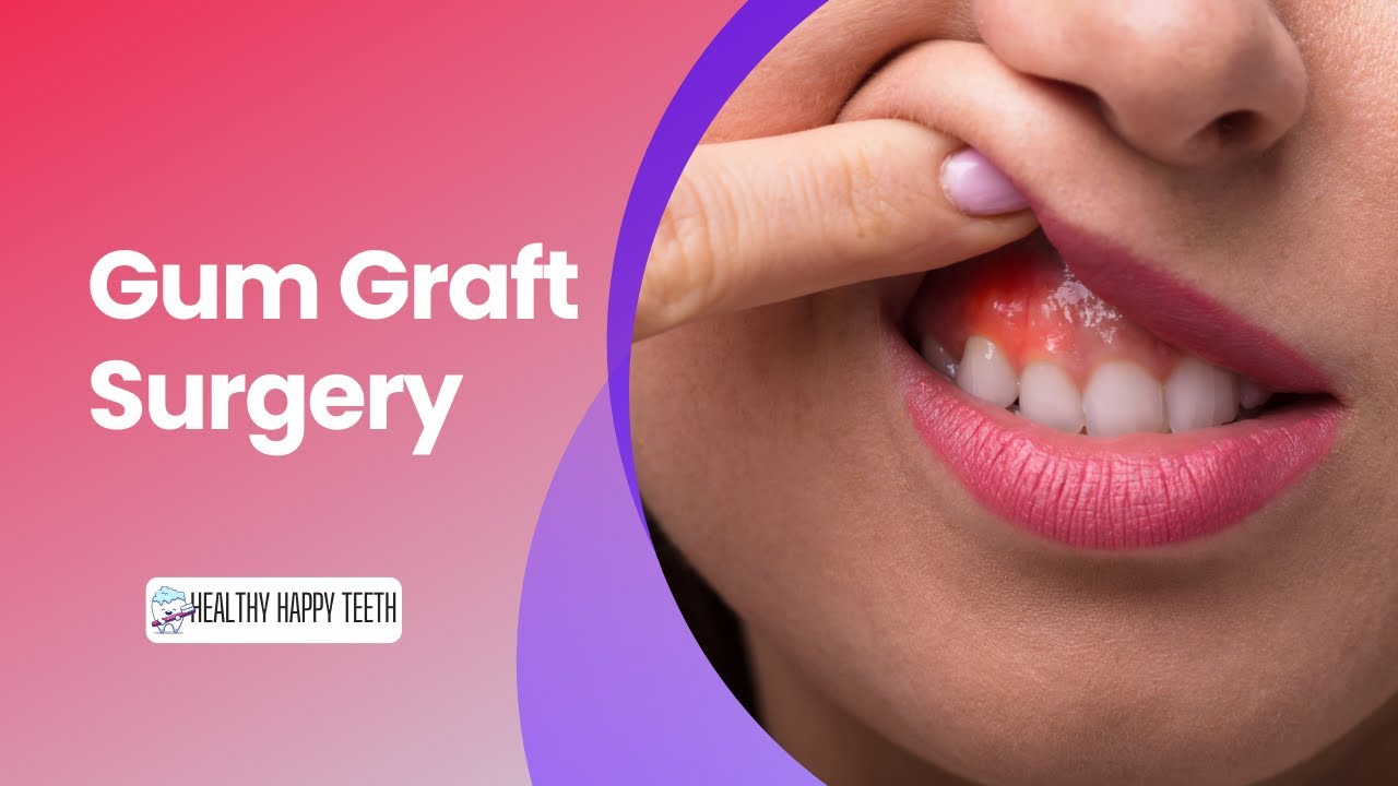 gum-graft-surgery-what-are-gum-grafts-youtube
