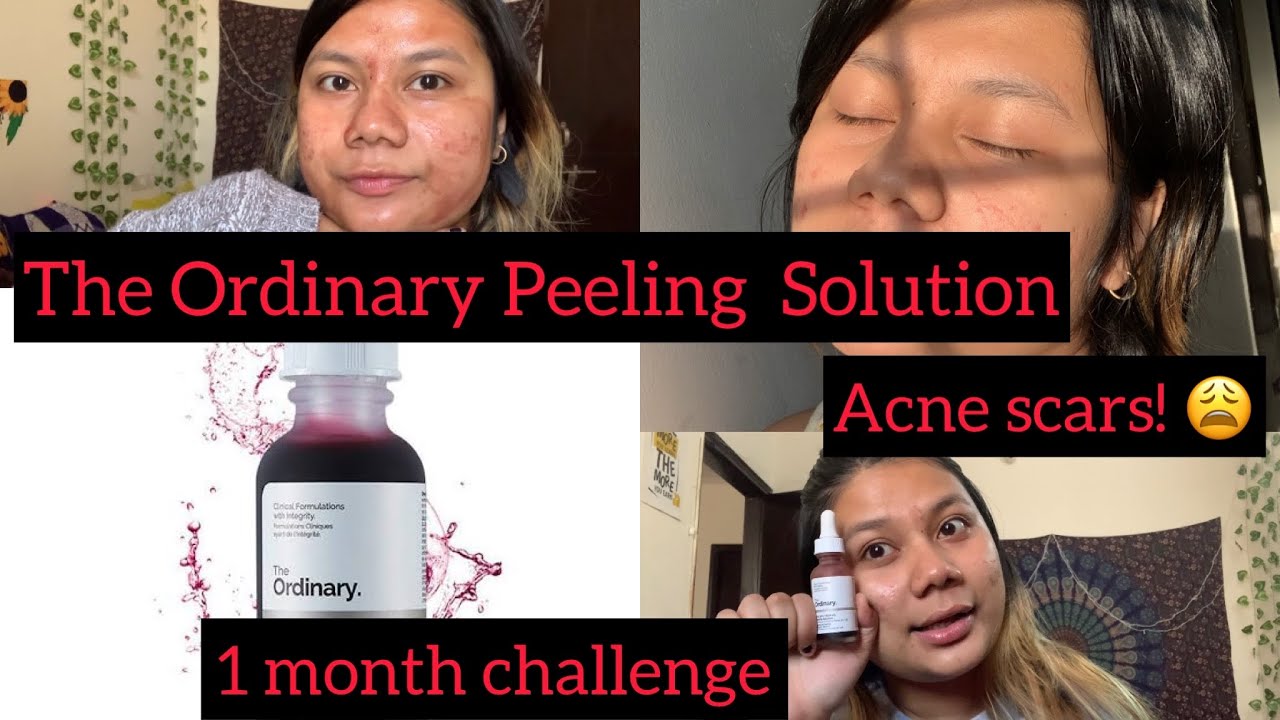 THE ORDINARY PEELING SOLUTION FOR ACNE SCARS ONE MONTH CHALLENGE .. FULL REVIEW| Faith Lemtur| 🌻 ...