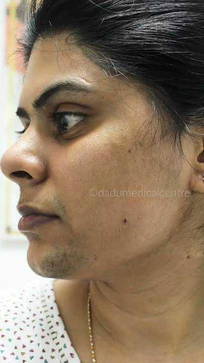 Laser Hair Reduction | Reduce unwanted hair growth | #Shorts | #YouTubeShorts | #ShortVideo