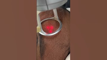 This is how Fractional CO2 laser treatment looks like| laser resurfacing #laserskinrejuvenation