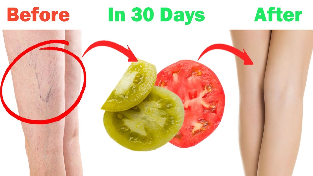 Best Home Remedies To Get Rid Of Varicose Veins In 15 Days. YouTube