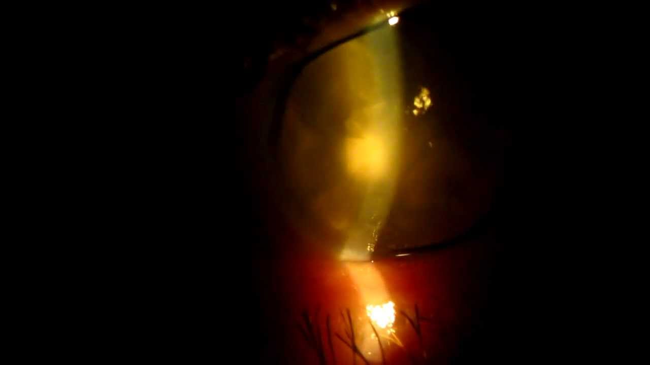 Вывих мутного хрусталика в переднюю камеру - YouTube