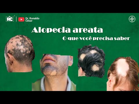 Alopecia areata o que você precisa saber