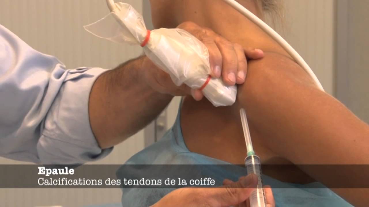 Echoms.info - Calcifications des tendons de la coiffe des rotateurs