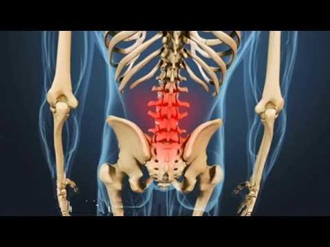 Sciatica le migliori opzioni di trattamento