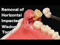 Removal of horizontal impacted wisdom teeth