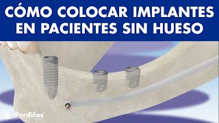 Cómo reponer DIENTES con IMPLANTES DENTALES si no TIENES HUESO ©