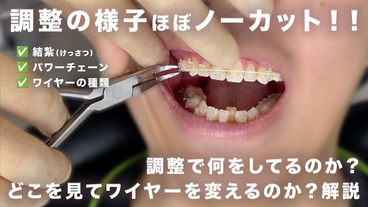 【矯正密着EP5】ワイヤー調整ほぼノーカット解説！【出っ歯→受け口⁉️】