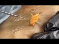 [ASMR] Sharp Ingrown Trimmed! Professional Pedicure DR LEE’S ULTIMATE ZITPOPPER 2509m2 0449