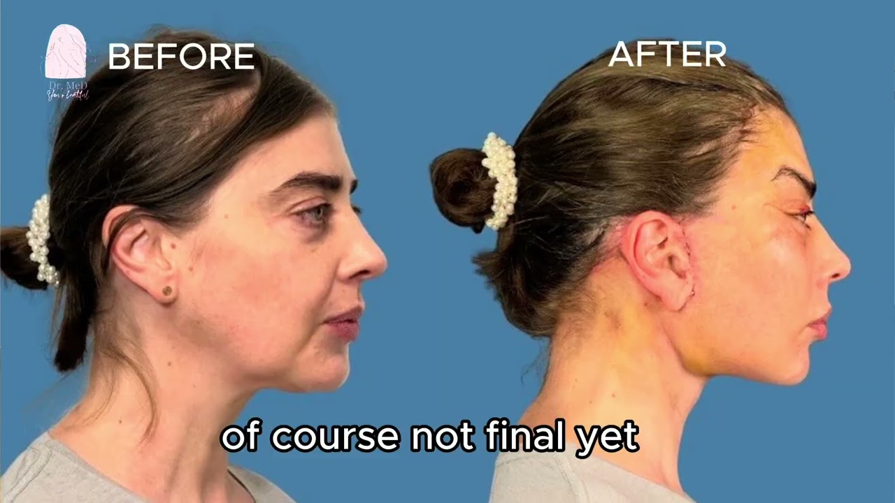 Face Lift Surgery Journey | Patient Interview and Before–After Experience