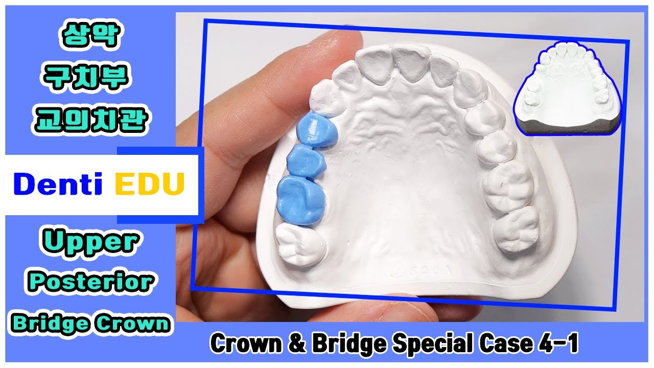관교의치 [상악 구치부 교의치(외형)] 역량강화TF 특별모형 4-1 [4K]