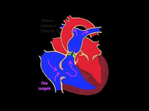 Vidéo: Malformation Cardiaque Congénitale (sténose Pulmonaire) Chez Le Chien