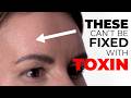 Sleep Line Correction With Filler: Full Tutorial