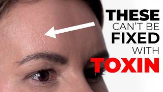 Sleep Line Correction With Filler: Full Tutorial