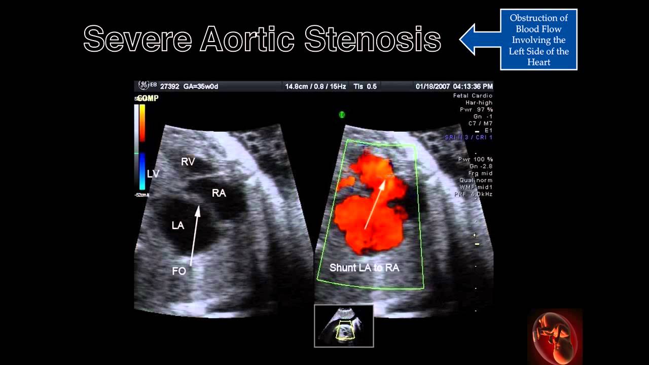 Fetal Pulmonary Stenosis