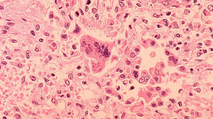 US measles outbreak largest since 2000