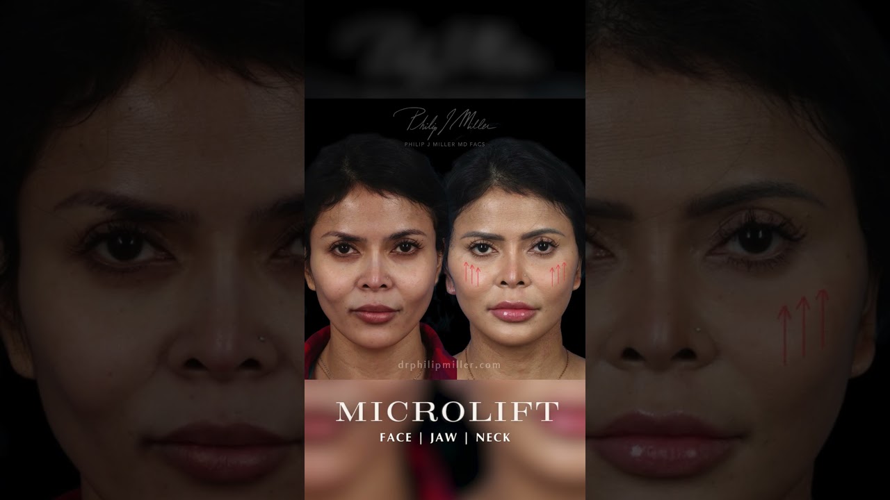 An deep plane facelift alternative! Short incisions SMAS lift targets mild-medium signs of aging!
