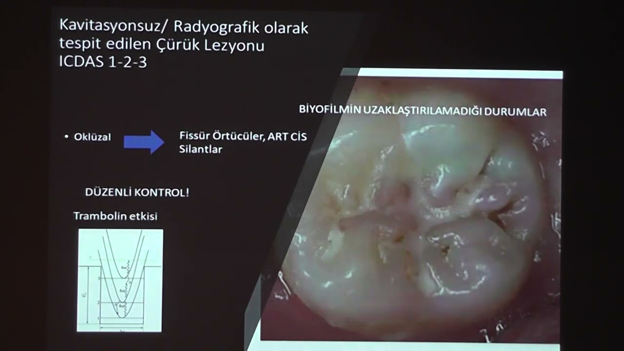 Çürük Lezyonuna Minimal İnvaziv Yaklaşım
