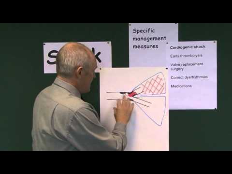 Shock 8, Management of Cardiogenic Shock