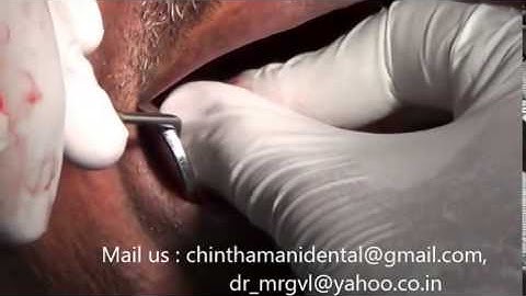 Painless extraction of molar rootstumps and immediate implants in India video part 2
