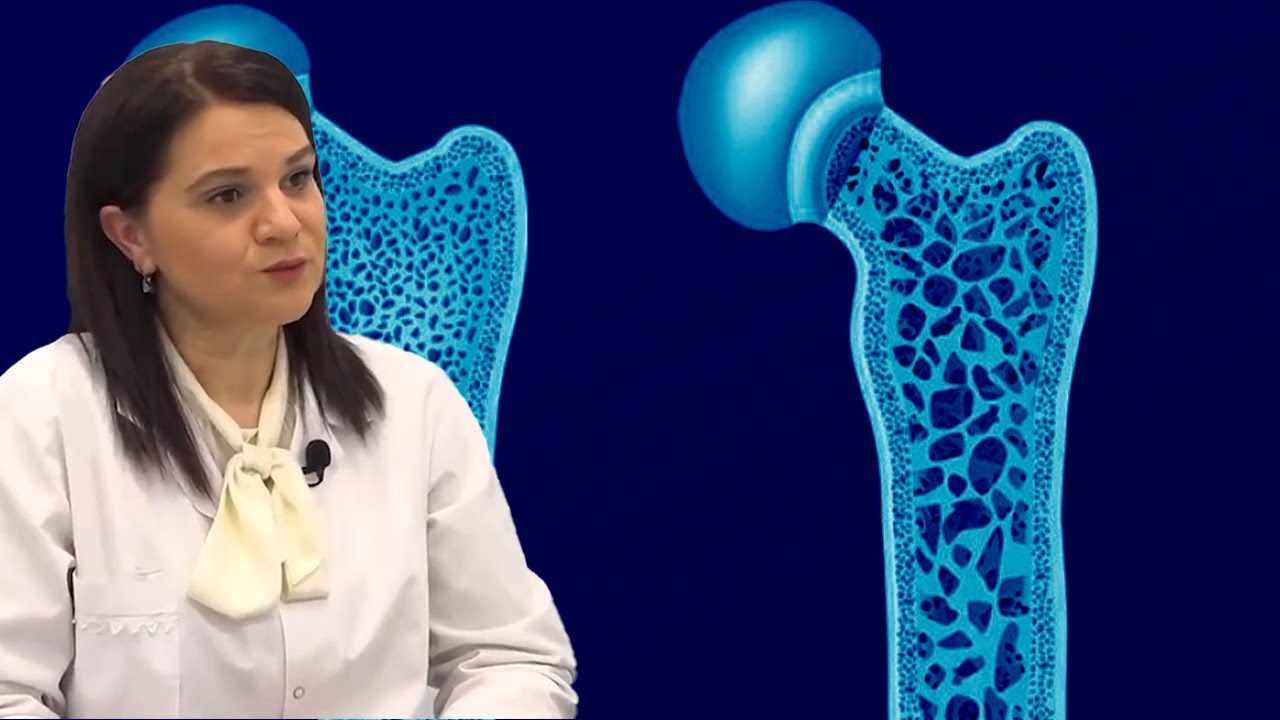 A ka shërim Osteoporoza! Flet mjekja Ergeta Ktona! | Dritarja e Doktorit
