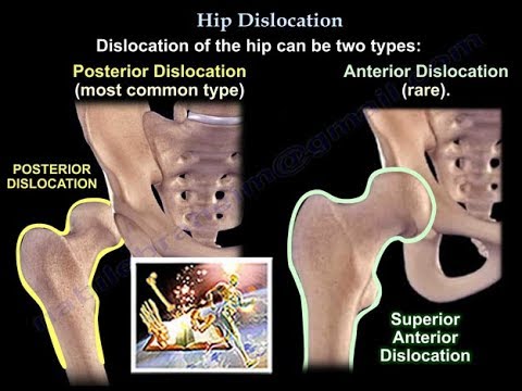 Video: Hip Dislocation - Symptoms, Diagnosis And Treatment Of Hip Dislocation. Prevention