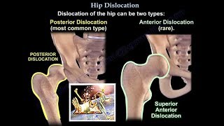 Dislocation of the hip - Everything You Need To Know - Dr. Nabil Ebraheim