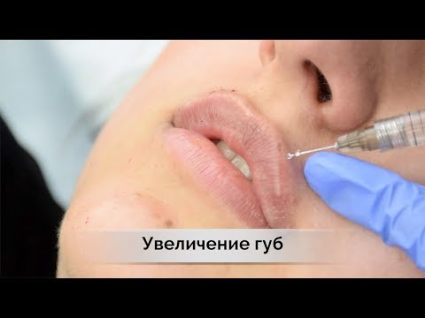 Увеличение губ или контурная пластика | филлеры  juvederm в Самаре   влог