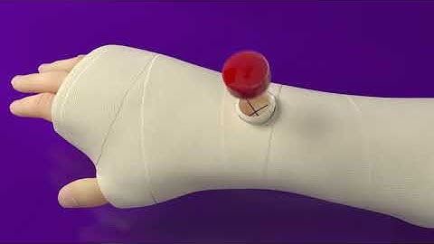 EXOGEN - Casting instructions for all installations