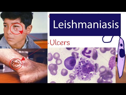 Video: Hoe om mukokutane leishmaniasis uit te spreek?