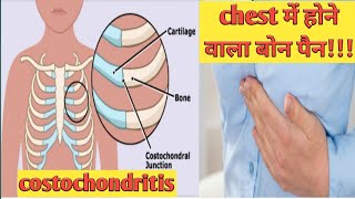 Orthopedic Chest Pain Costochondritis In Hindi - Teitze Syndrome In Hindi
