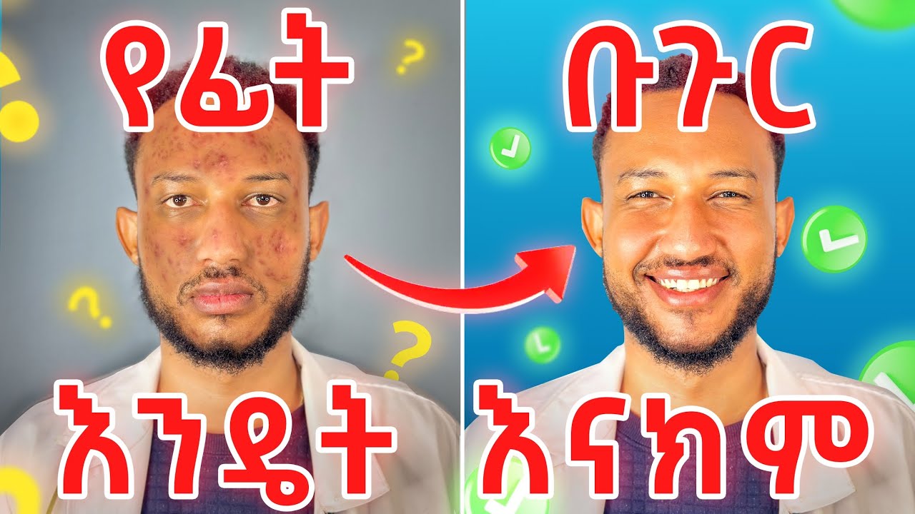 ቡጉር ማጥፊያ መንገዶች || How to treat facial Acnes