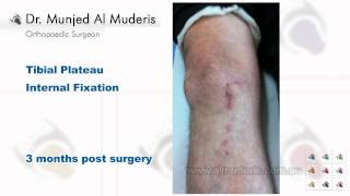 Tibial Plateau Internal Fixation - 3 months post surgery