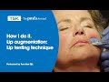 Lip augmentation: Lip Tenting Technique by Tom van Eijk