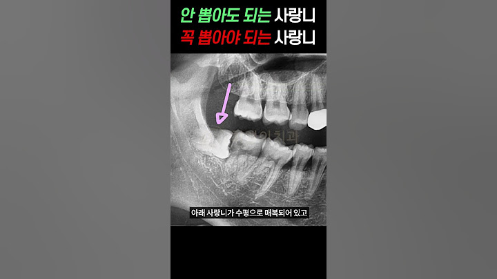 이런 경우에는 절대 사랑니 뽑지 마세요! #shorts
