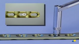 Technique - Locking Compression Plate (LCP) Application