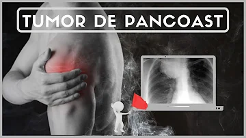 ¿Qué causa un tumor de Pancoast?
