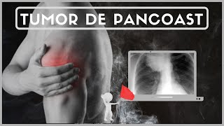 TUMOR DE PANCOAST Y DOLOR DE HOMBRO- Signos y síntomas