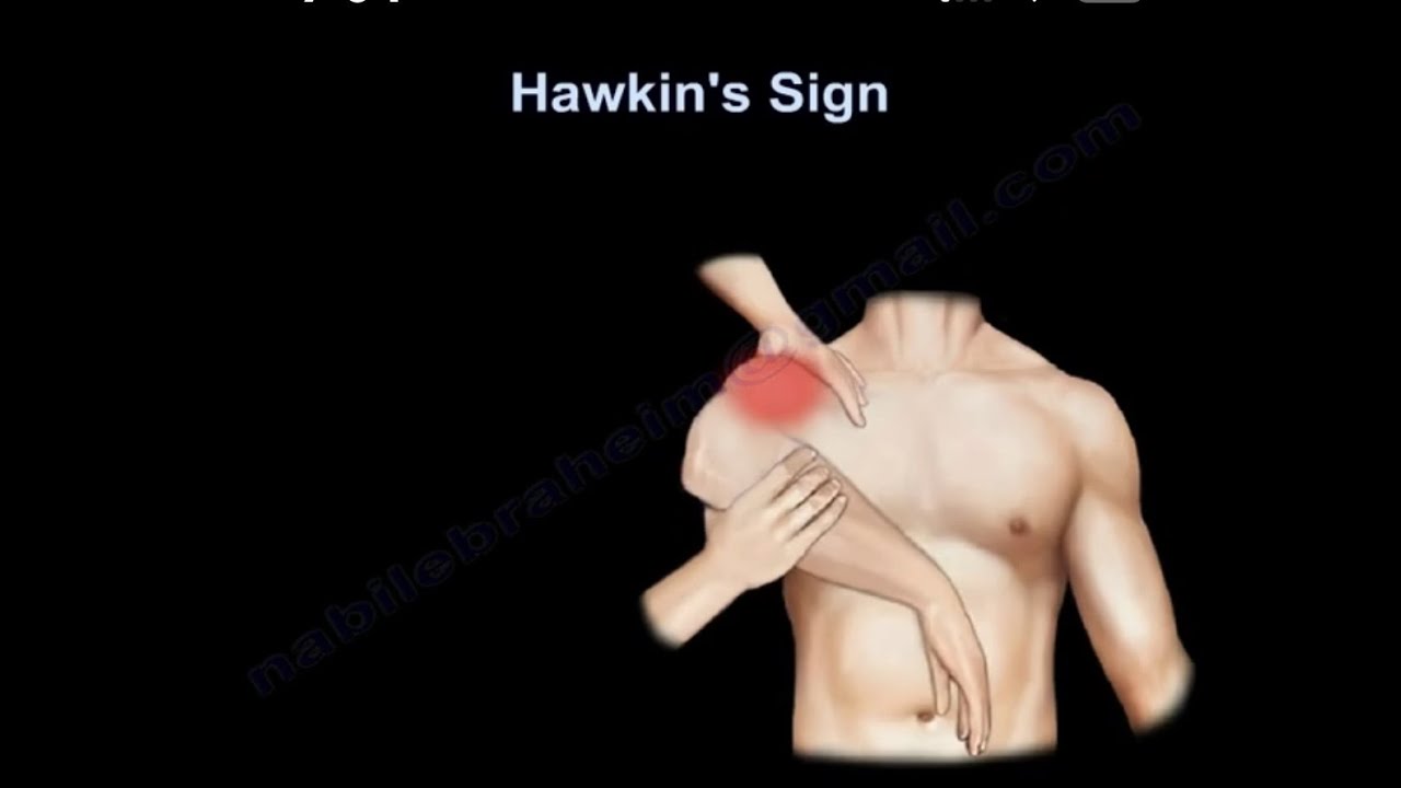 Hawkin s Sign Shoulder Impingement YouTube hawkin-s-sign-shoulder-impingement-youtube