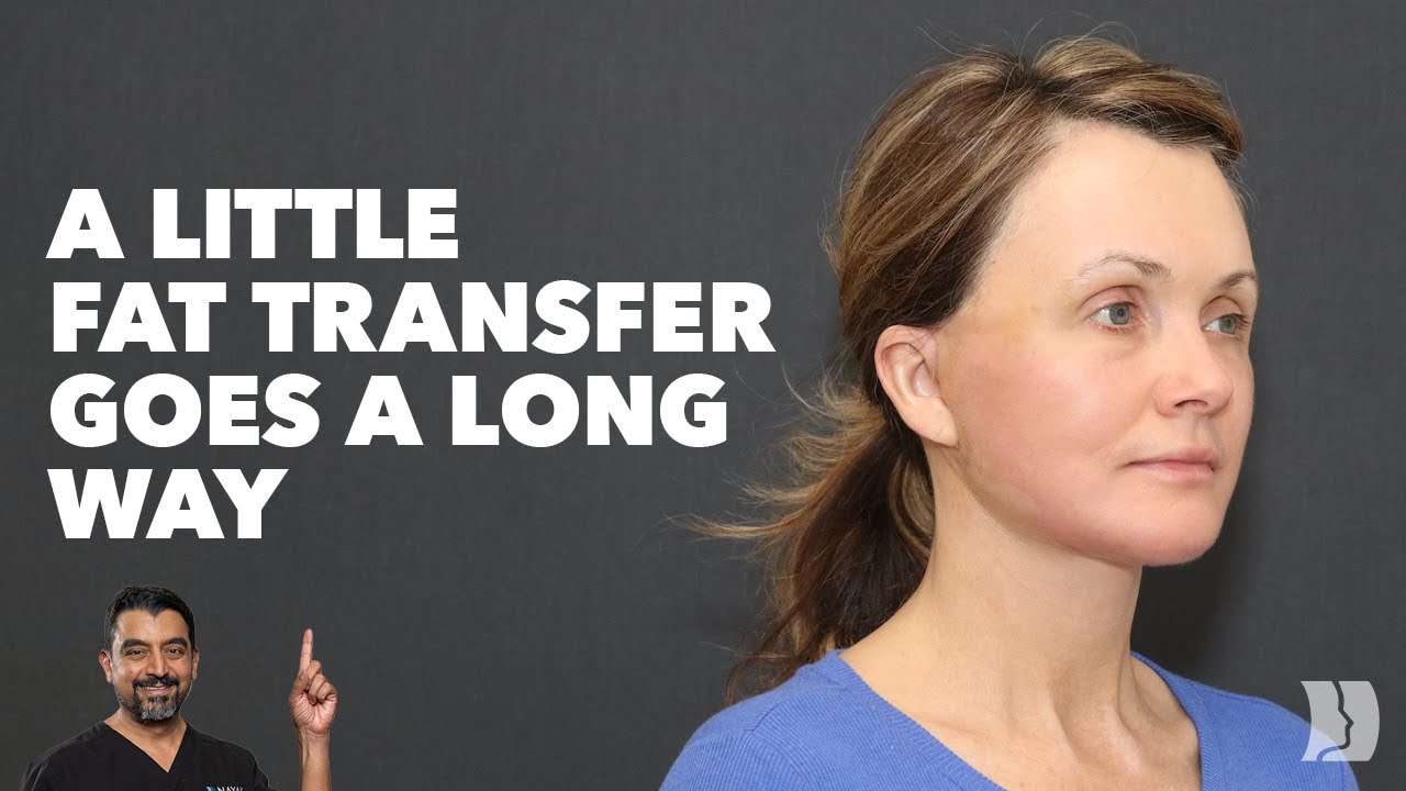Fat Transfer or Fillers for Your Face?