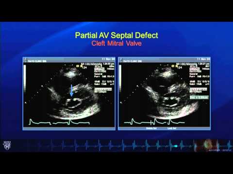 எக்கோ டுடோரியல்: பிறவி இதய நோய் உள்ள பெரியவர்களின் எதிரொலி மதிப்பீடு - மயோ கிளினிக்