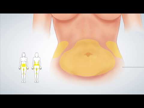 Video: Onkologiske Resultater Efter øjeblikkelig Brystrekonstruktion Efter Mastektomi: Sammenligning Af Implantat Og Klap Ved Hjælp Af Matchning Af Tilbøjelighed