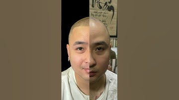 ae xem ngay quả review xăm tóc , trước và sau, hói chữ m, hói đỉnh đầu.. #xămtóc