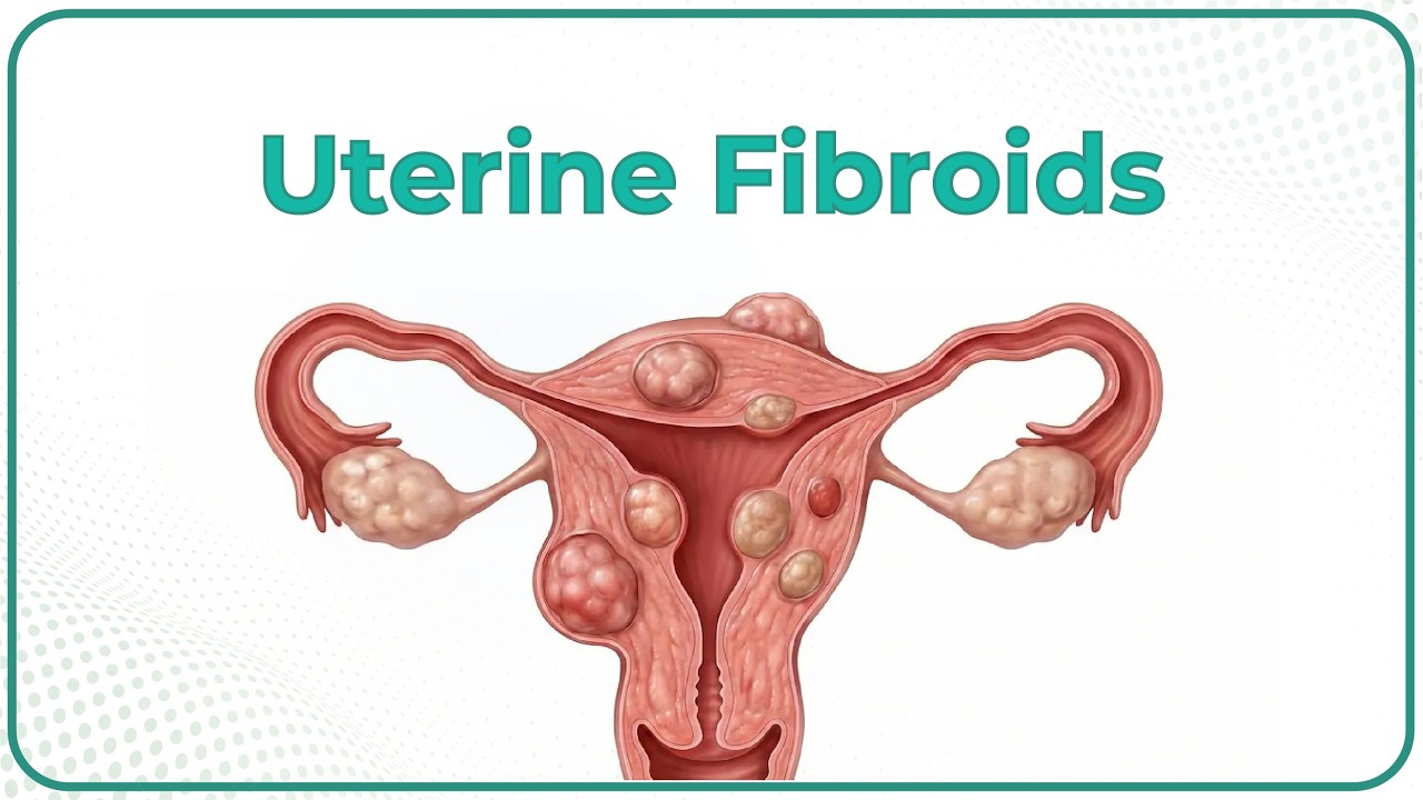 Fibroid Classification Uterine Fibroid Diagram Uterine Fibroid Diagram Stock Illustrations