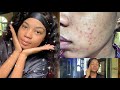 MY AFFORDABLE SKIN CARE ROUTINE || Before & after videos included