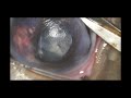 Pequinitta encephalitozoonose cataracte intracapsulaire