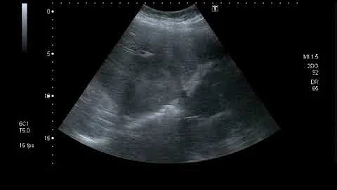 Cosa provoca l angioma al fegato?
