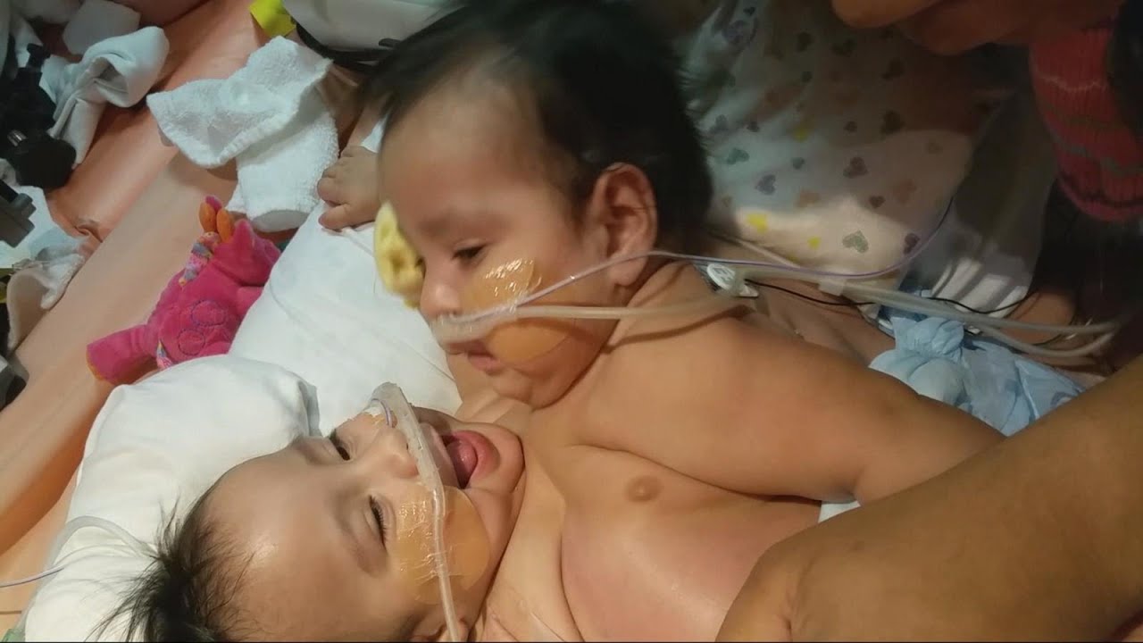 Conjoined Twins Undergo Complicated Separation Surgery